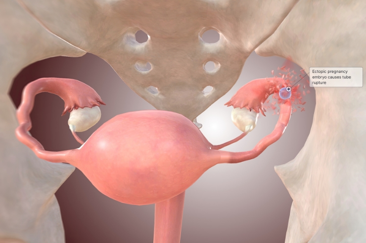 Ectopic Pregnancies----33