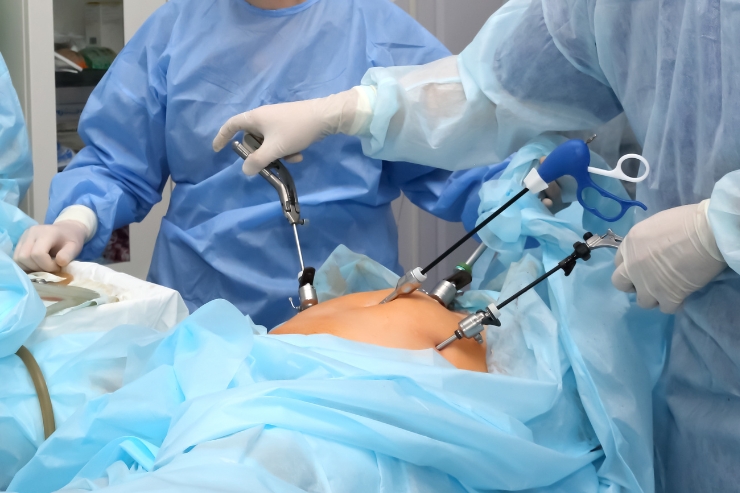 Laparoscopic _ Open Tubectomy------32